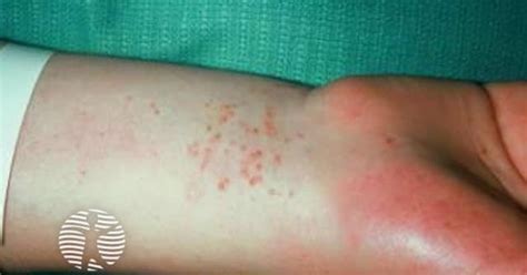 Gonococcaemia image