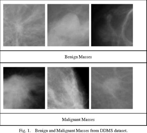 Figure 1 From Deep Learning Based Computer Aided Diagnosis System For Breast Mammograms