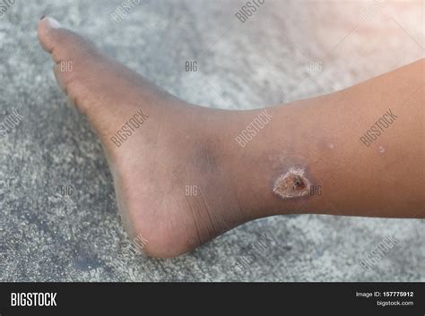 Infected Wound On Leg Image & Photo (Free Trial) | Bigstock