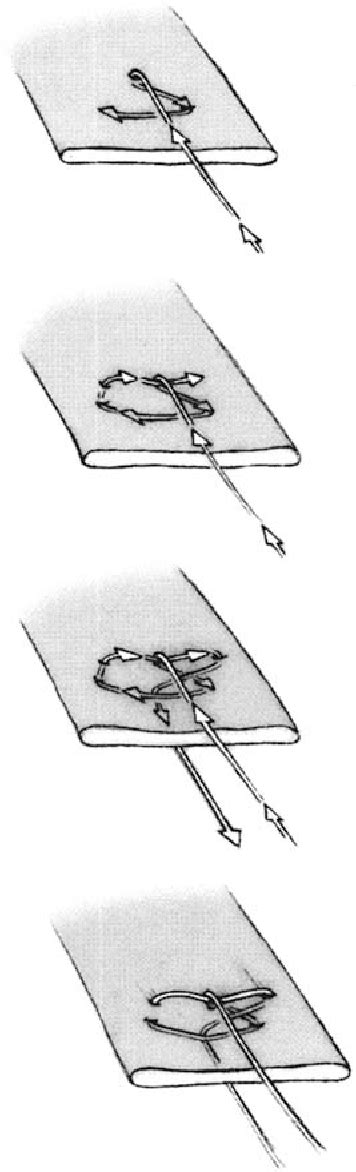 Pdf A Modified Mason Allen Technique For Rotator Cuff Repair Using