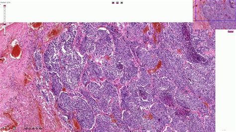 Small Cell Carcinoma Histology