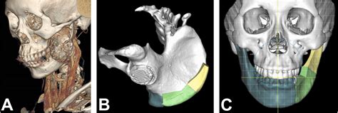 Mandibular Reconstruction Using An Iliac Bone Flap With Perforator