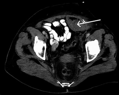 Computed Tomography Scan Showing Haematoma In The Left Rectus Sheath