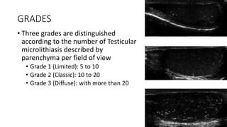 Testicular Microlithiasis Pptx