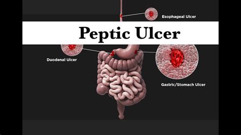 Peptic Ulcer Surgery By Asm Minds Team Youtube