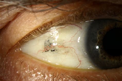 Atlas Entry - Subconjunctival foreign bodies
