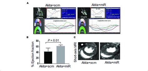 Mir 133a Mimic Treatment Improves Systolic Dysfunction Of Akita A