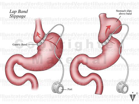 Stock Bariatric Lap Band Procedure — Illustrated Verdict