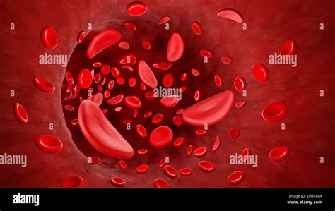 Sickle Cell Anaemia Illustration Stock Photo Alamy