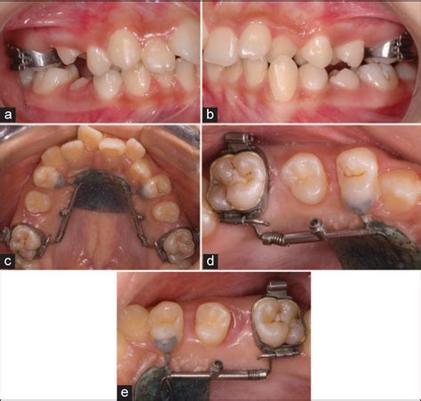 Maxillary Distalization With Tads Orthodontic Products Off