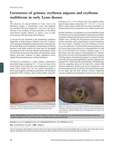 Coexistence Of Primary Erythema Migrans And Erythema Multiforme In