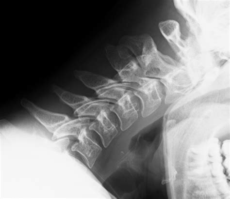 Spina Bifida Occulta Cervical Spine Image