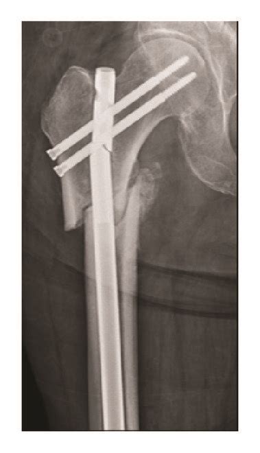 A Atypical Right Subtrochanteric Femur Fracture Created In A