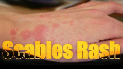 Scabies Rash Distribution