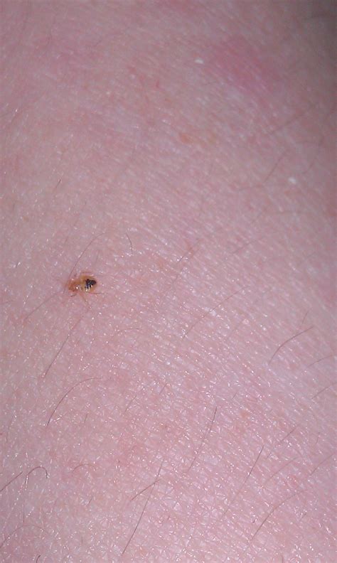 How To Identify Bed Bug Bites On Humans | wasaga beach break fast ca