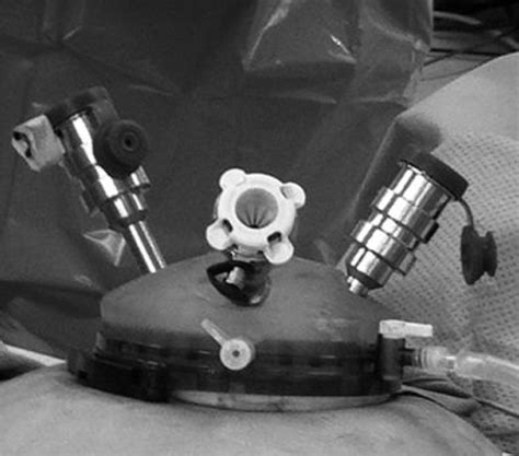 Single Incision Robotic Assisted Laparoscopic Hysterectomy Journal Of