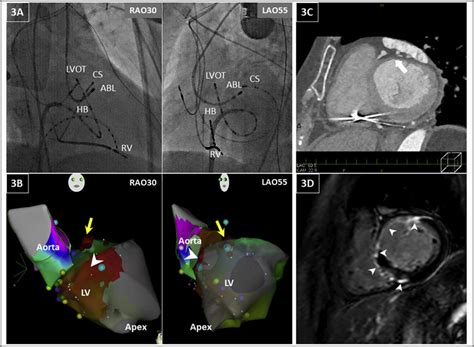 Fluoroscopic Views Electro Anatomical Maps And Cardiac Images 3A