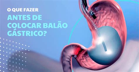 Como Se Preparar Para Colocar O Bal O G Strico Cl Nica Edt