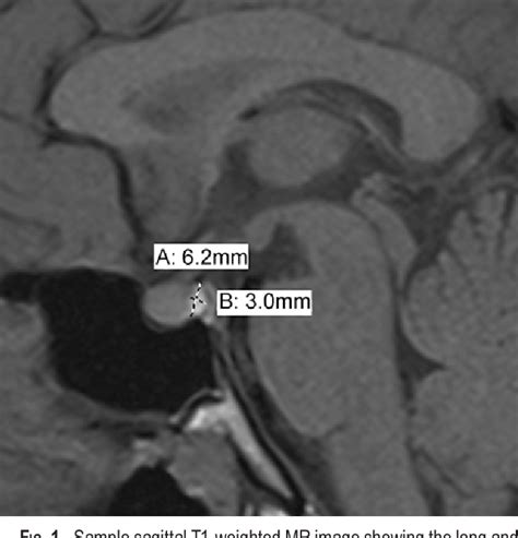 Normal Pituitary Mri T2