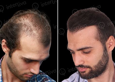 Hair Transplant Before And After Photos Interliva Hair