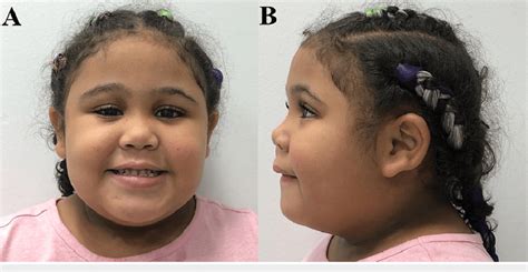 Facial Features In Our Puerto Rican Chrna7 15q133 Microdeletion Case