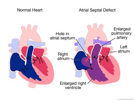 Atrial Septal Defect