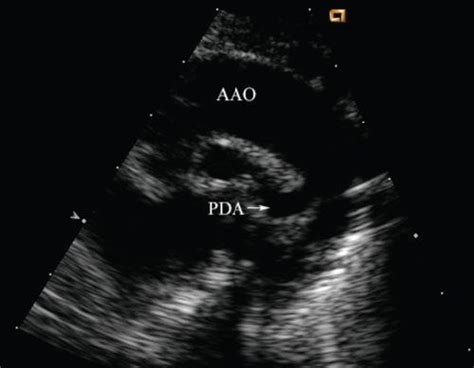 Patent Ductus Arteriosus and Aortopulmonary Window | Thoracic Key