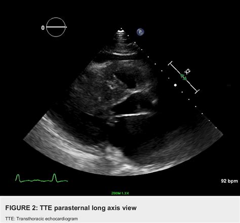 [pdf] Subaortic Membrane Mimicking Hypertrophic Cardiomyopathy In The Setting Of Mitral Valve