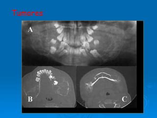 FRACTURA MANDIBULAR PPT