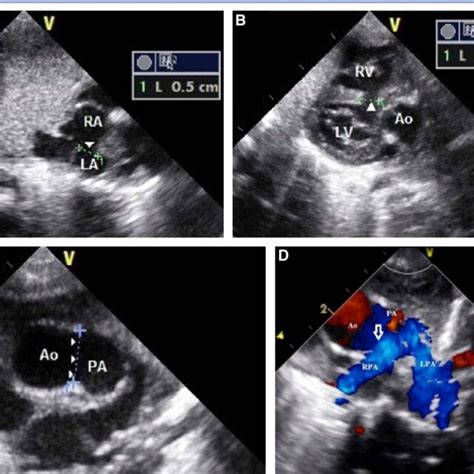 A Echocardiographic Images Illustrating Mm Atrial Septal Defect Of