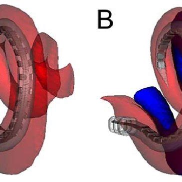 Reconstructed CT images showing a cochlear implant completely within ...