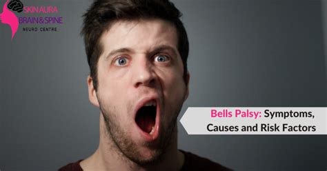 Bells Palsy Symptoms Causes And Risk Factors