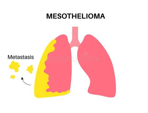 Mesothelioma Cancer Disease Stock Illustration Illustration Of