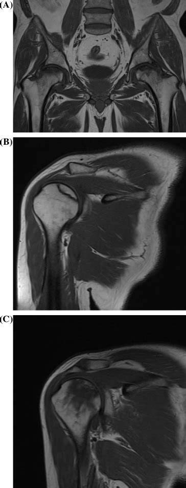 Mri Images A Preoperative T Weighted Mri Scans Of Both Hips