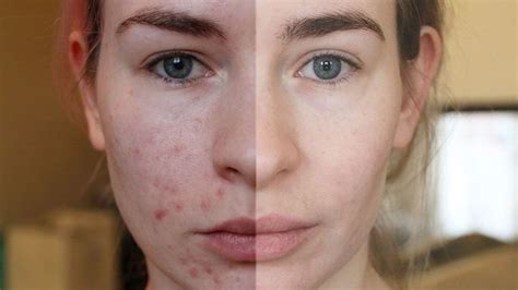 uk nhs dermatology experience accutane