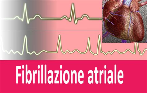 Limportanza Degli Interventi Mirati Nei Casi Di Fibrillazione Atriale