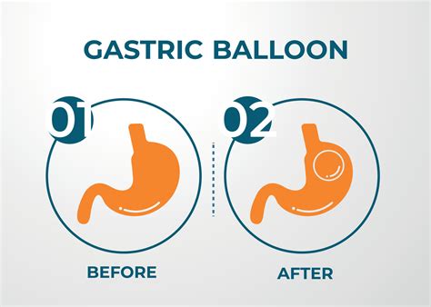 balão gástrico de endoscopia de estômago dentro de uma cirurgia de ...