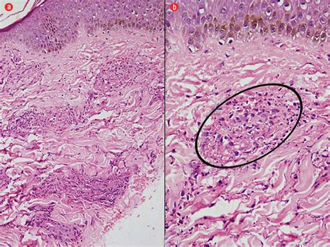 A Hematoxylin And Eosin Staining Of Skin Biopsy Samples Revealing