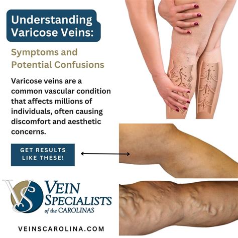 Understanding Varicose Veins Symptoms And Potential Confusions Vein