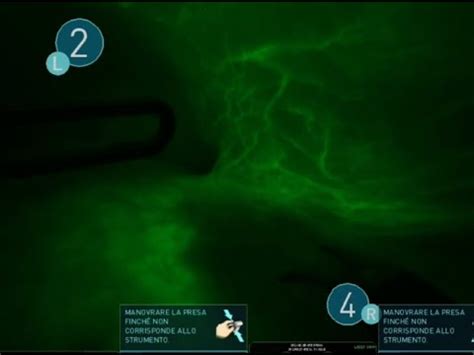 Robotic Segment Anatomical Liver Resection After Robotic Right