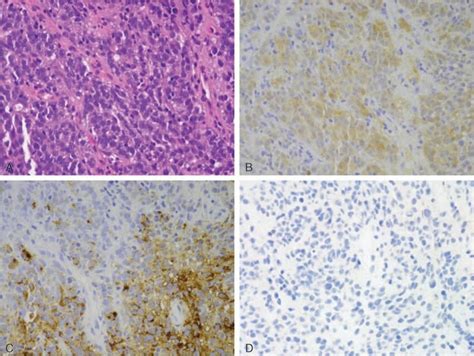 Pathohistological Examination Of The Biopsy Sample A Proliferation