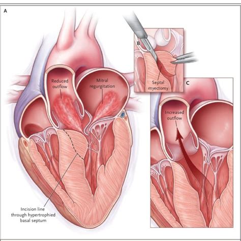 Schematic Diagram of a Patient Undergoing Surgical Septal Myectomy ...