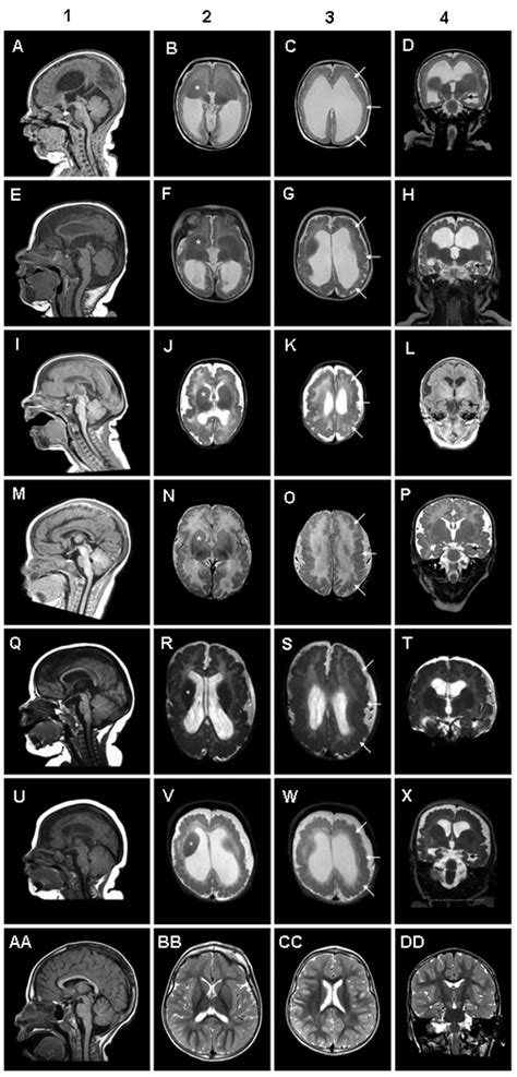 GRIN2B Related Neurodevelopmental Disorder GeneReviews NCBI Bookshelf