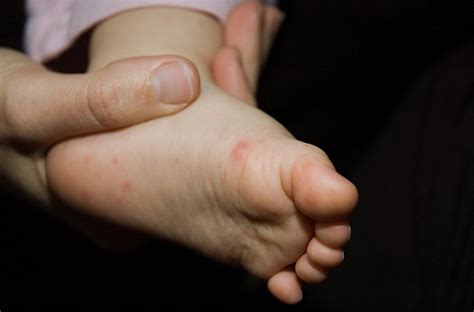 Explainer Why Children Are At Risk Of Hand Foot And Mouth Disease