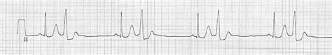 QRS Interval • LITFL • ECG Library Basics