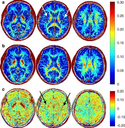 Figure 2 From Rapid Whole Cerebrum Myelin Water Imaging Using A 3D