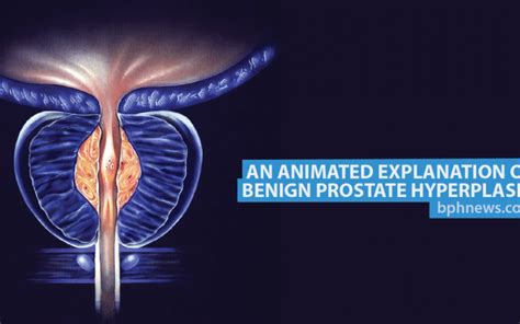 Blood Micrornas Can Help Distinguish Between Prostate Cancer Bph