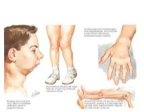 Clinical Signs Of Oligoarticular And Polyarticular Juvenile Idiopathic