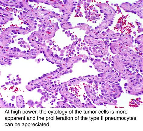 Pathology Outlines Adenocarcinoma Overview