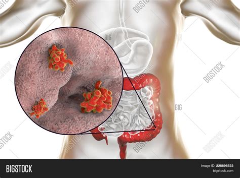 Entamoeba Histolytica Image And Photo Free Trial Bigstock